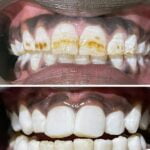 Deep teeth cleaning is an extensive cleaning of the teeth