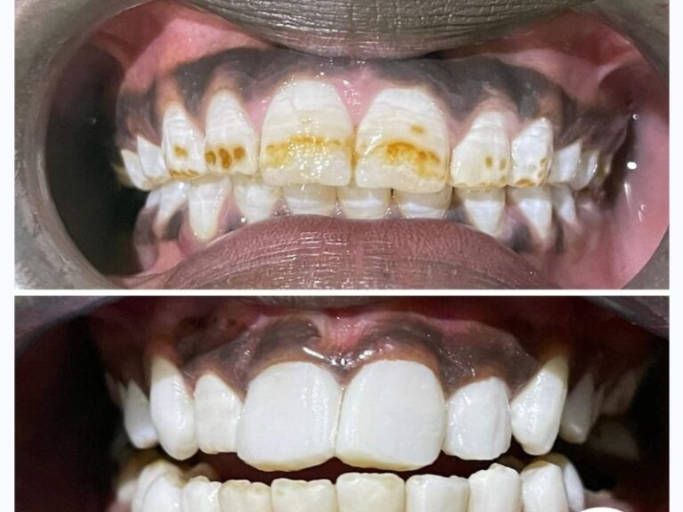 Deep teeth cleaning is an extensive cleaning of the teeth